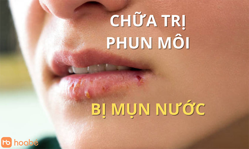 Phun môi bị mụn nước hoa bé